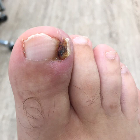 Fungal Nail Image