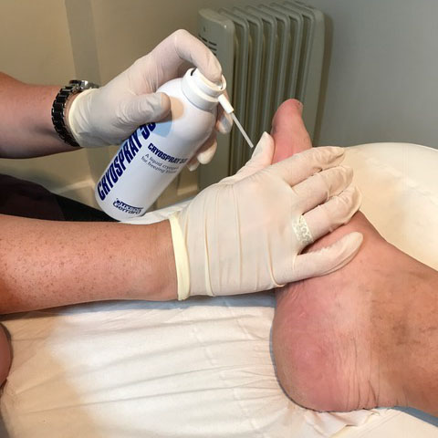 Cryo Treatment