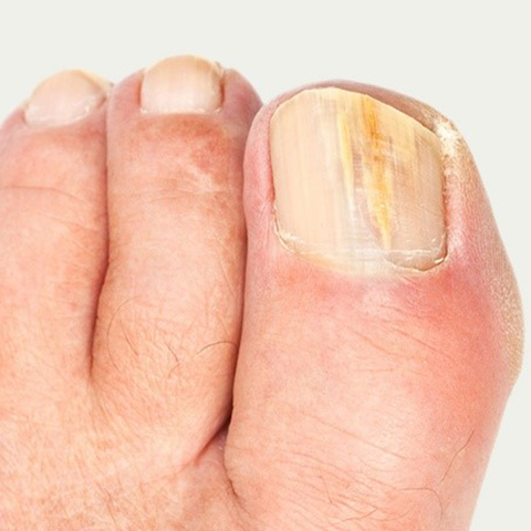 Fungal nail