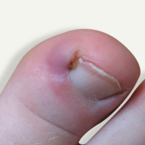 Ingrown toenail