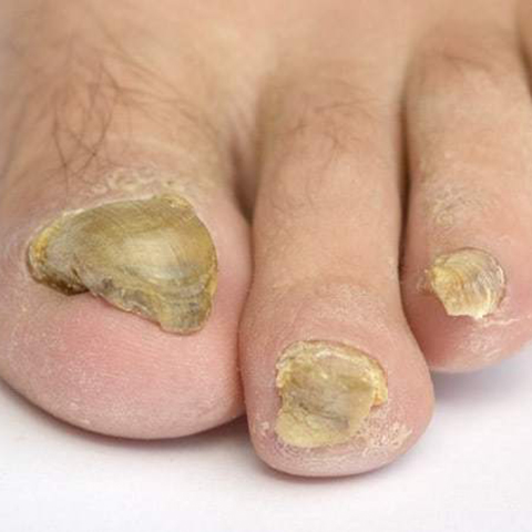 Toenail Fungus