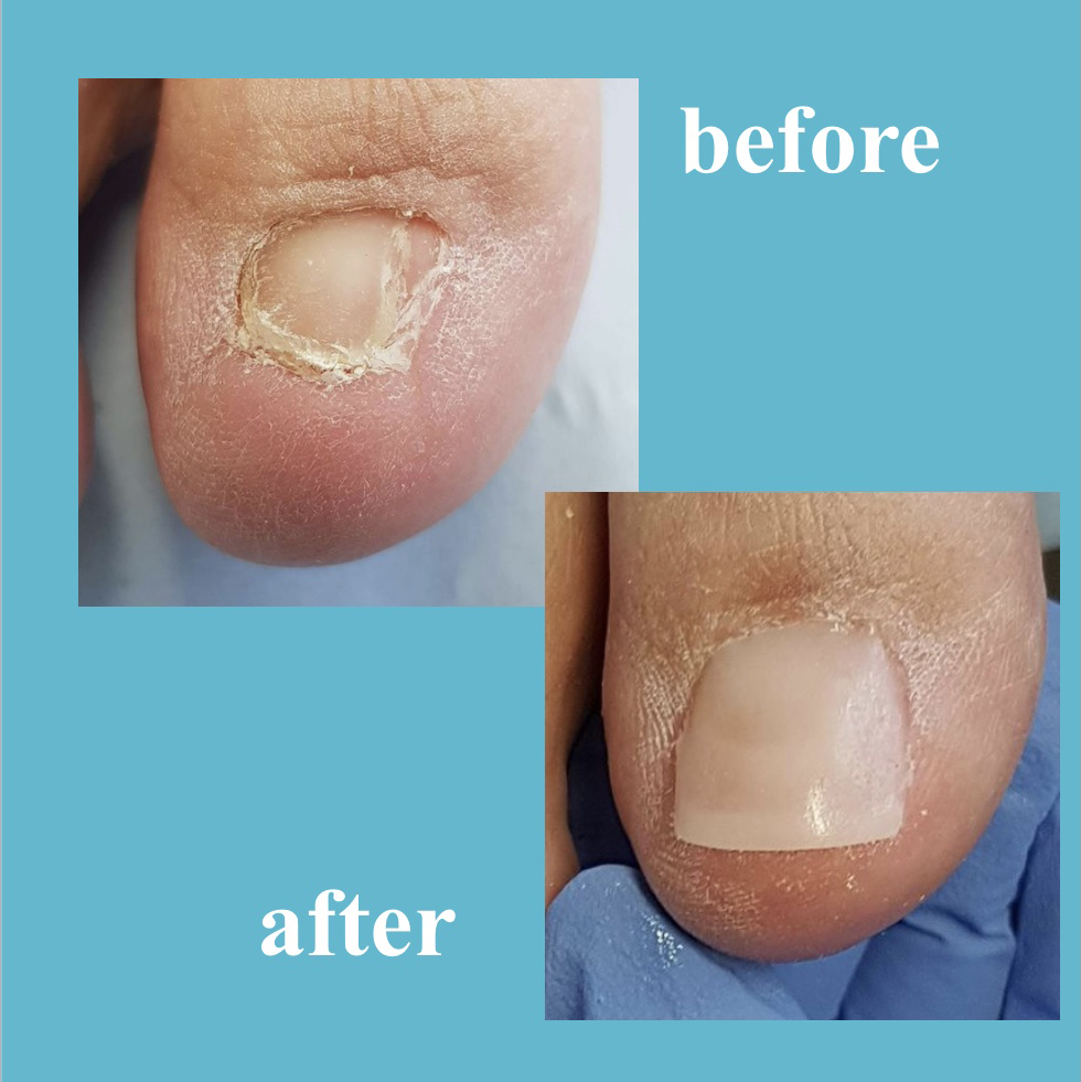 Nails Before and After Pedisafe